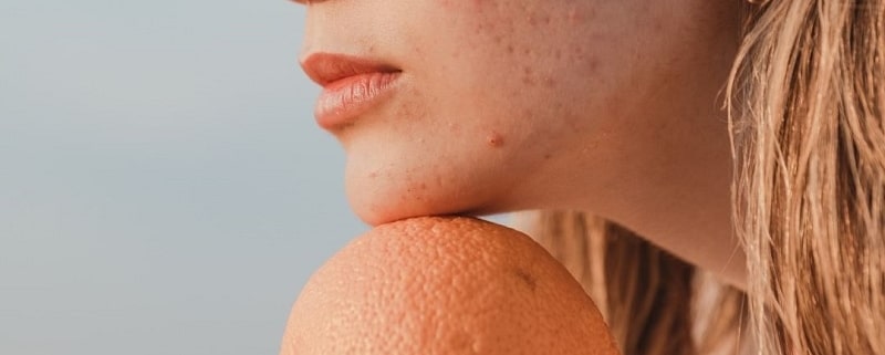 Tips to Get Rid of Hyperpigmentation on Face
