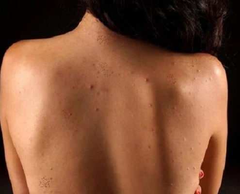 Top 5 Ways to Get Rid of Back Acne