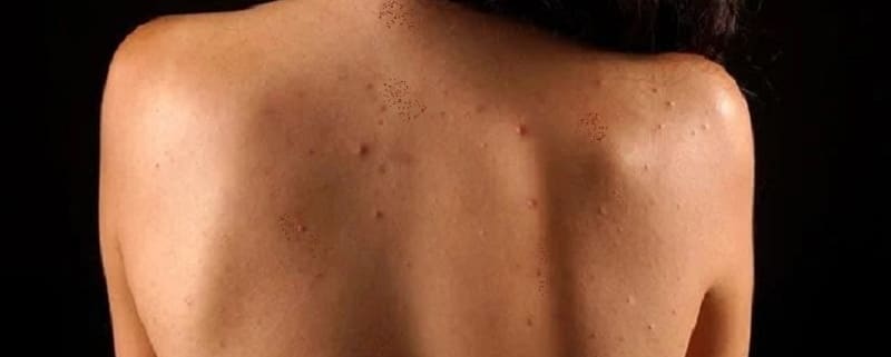 Top 5 Ways to Get Rid of Back Acne