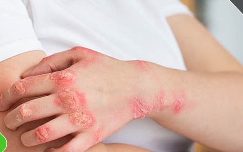 Treats Skin Infection