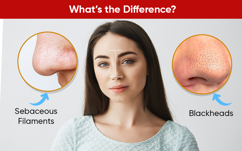 Sebaceous Filaments vs Blackheads