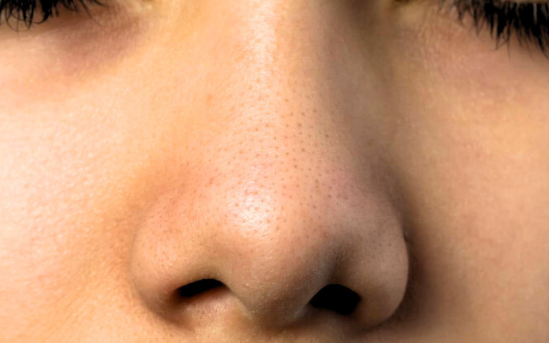 Sebaceous Filaments vs Blackheads