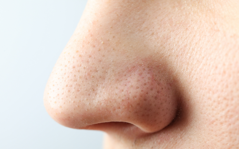 What Are Blackheads